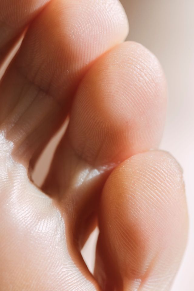 Plantar Warts A Guide to removal