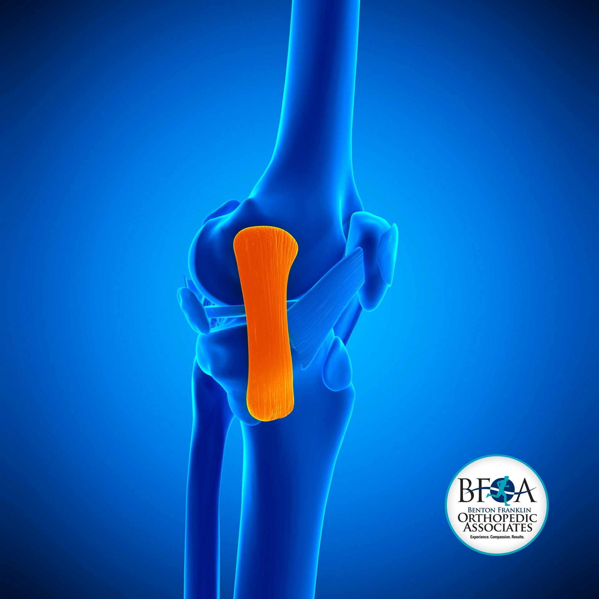 Medial Collateral Ligament (MCL) tears at BFOA