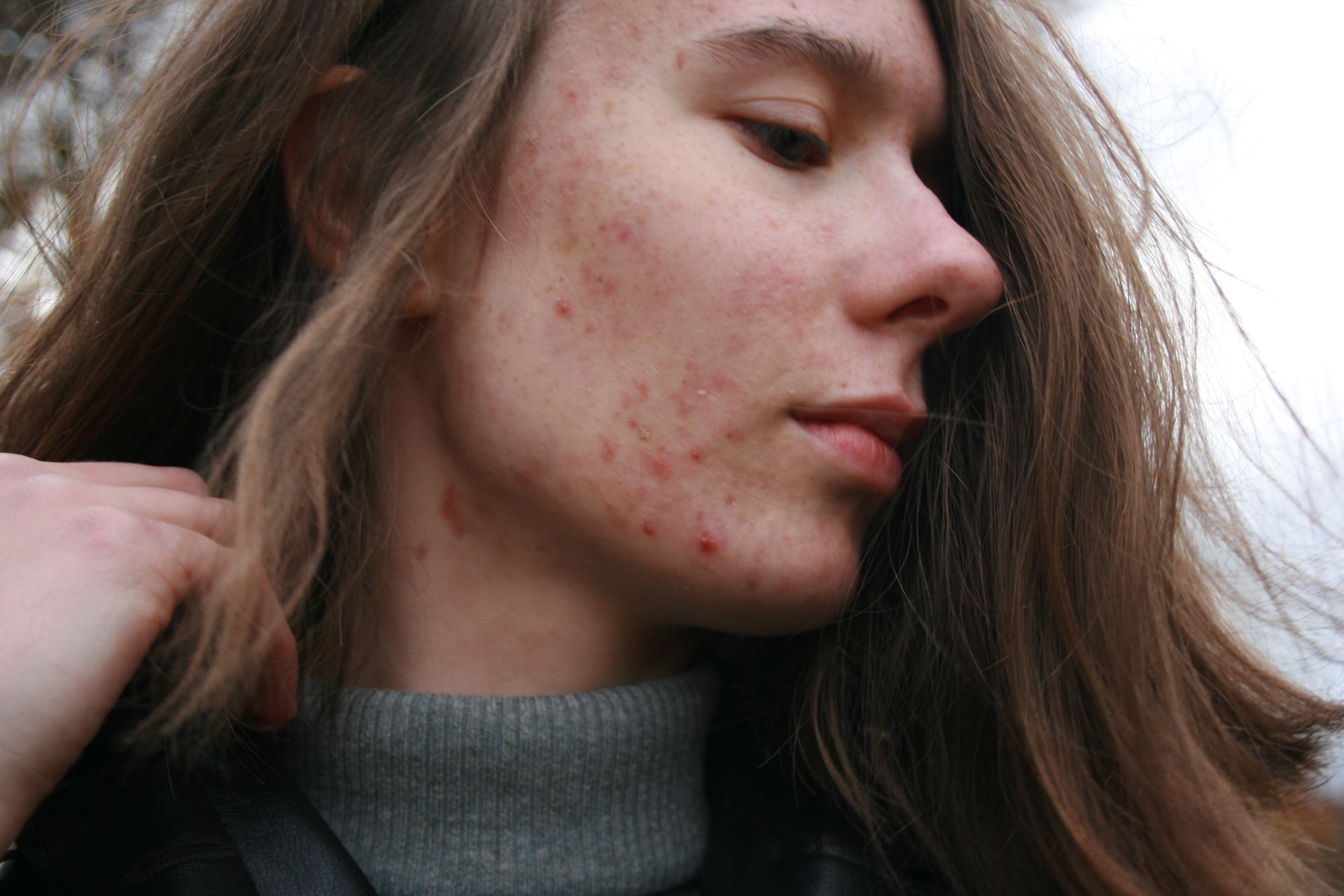 PCOS acne