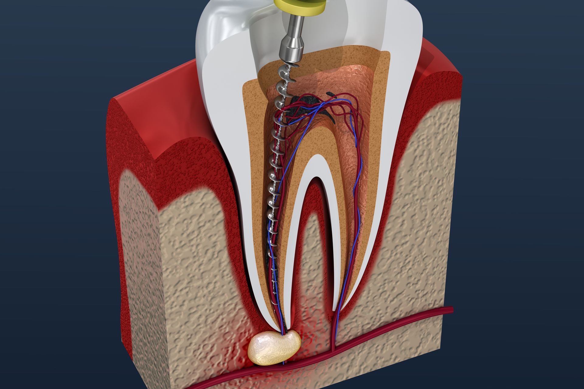 Cross-section of tooth undergoing root canal treatment; yellow tool in root canal, reddish tissue, infection visible.