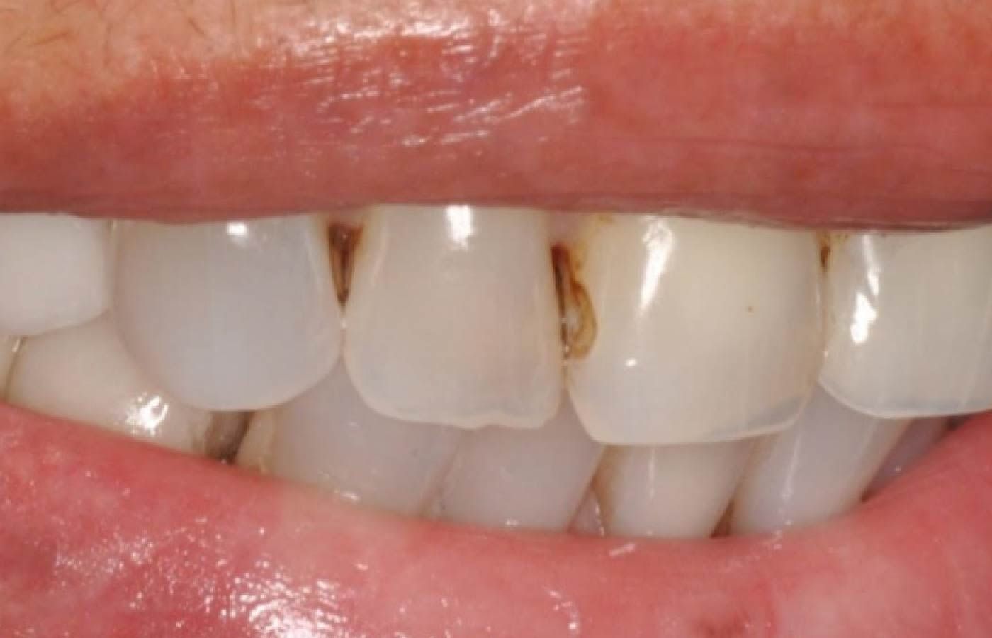 Close-up of teeth with several cavities and discolored areas, visible when smiling.