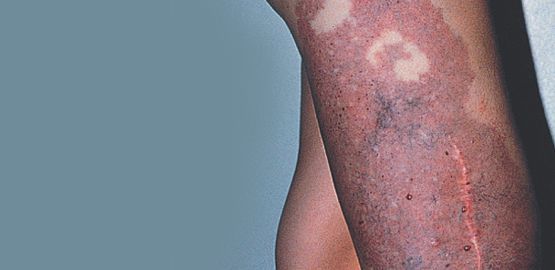 Leg affected by Klippel-Trenaunay (KT) syndrome with varicose veins and birthmark, LEDAS vein clinic Busan