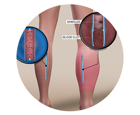 Illustration of deep vein thrombosis, a possible complication of untreated varicose veins, LEDAS