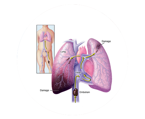 Illustration of pulmonary embolism from a leg vein clot, varicose vein complication explained by LEDAS