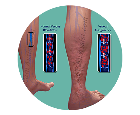 Chronic venous insufficiency skin changes in the lower leg – LEDAS vein clinic Korea