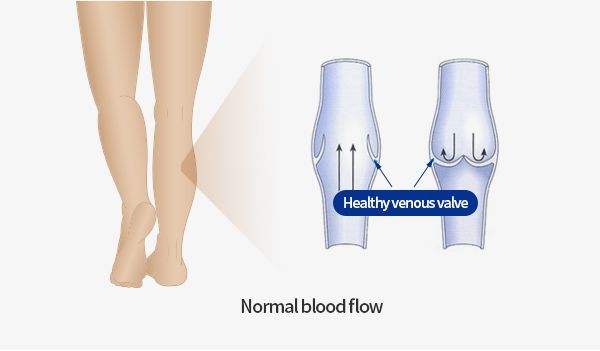 Diagram explaining what varicose veins are and their causes, LEDAS FAQ
