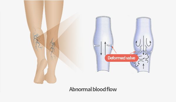 Diagram of venous reflux causing leg and ankle swelling from varicose veins, LEDAS Busan