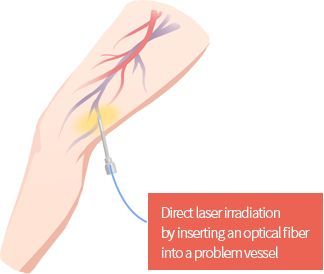 Endovenous laser treatment (EVLT) of a varicose vein at LEDAS clinic, Busan