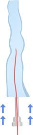 Laser fiber entering a vein during EVLT, compared with radiofrequency ablation (RFA), LEDAS Busan