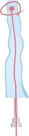 Laser energy sealing the inner wall of a varicose vein during EVLT at LEDAS, Busan