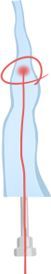 Vein occlusion after EVLT showing how varicose vein treatment results develop at LEDAS, Busan