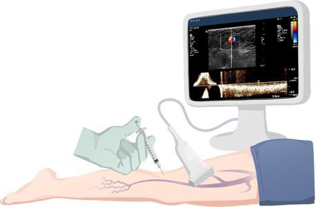 Non-surgical ultrasound-guided varicose vein treatment at LEDAS clinic, Busan, Korea