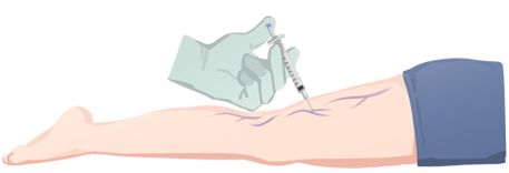 Sclerotherapy injection into visible spider and reticular leg veins at LEDAS clinic, Busan, Korea