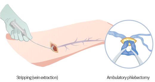 Traditional vein stripping surgery and ambulatory phlebectomy compared with LEDAS modern treatment