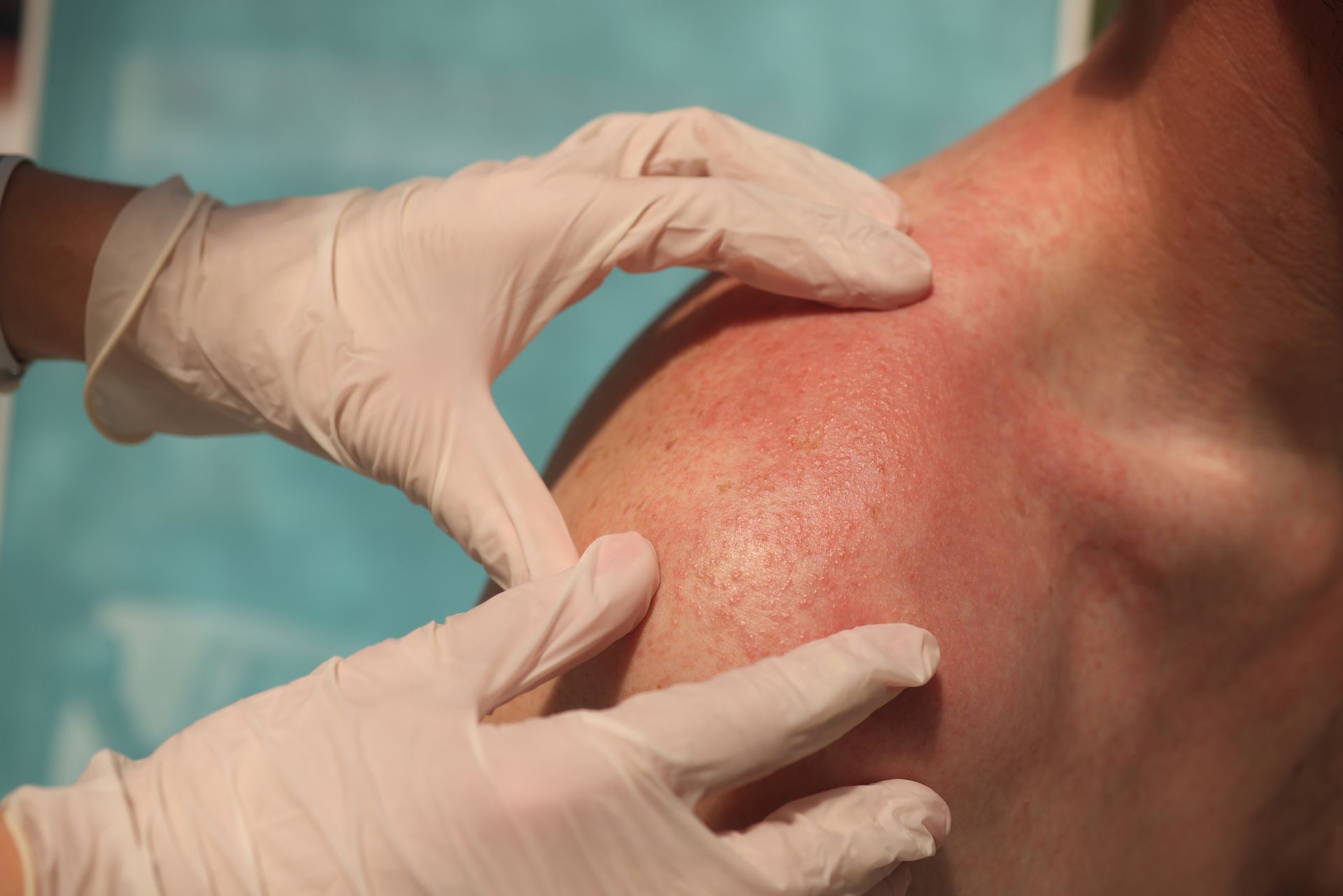 A person wearing gloves is examining a person's shoulder.