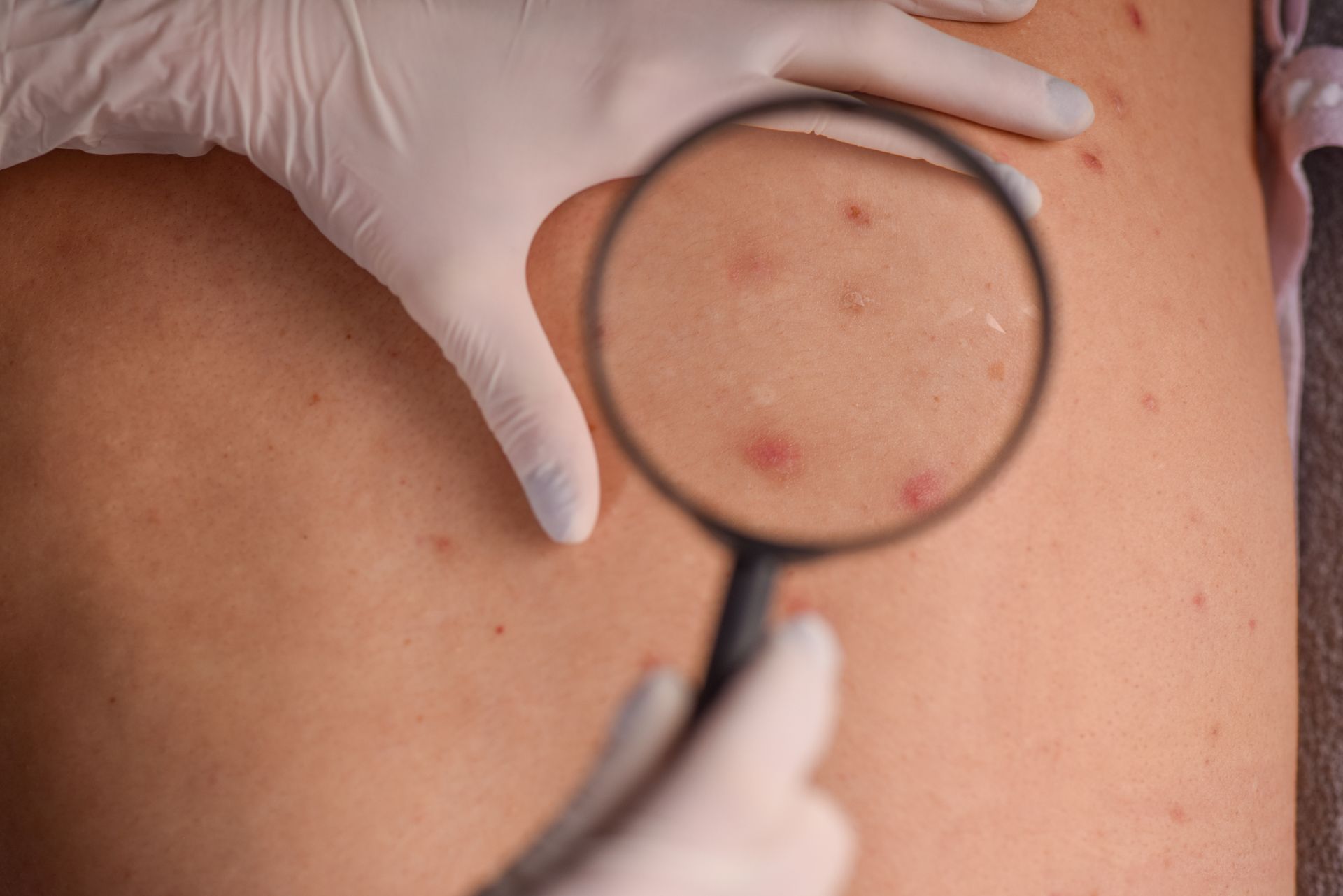 Doctor examining patient's skin for cancer at a modern skin cancer clinic with dermatoscope.