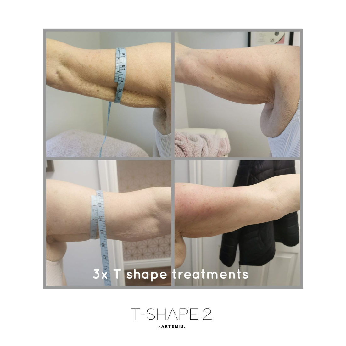 A picture of a woman 's arm before and after 3x t shape treatments