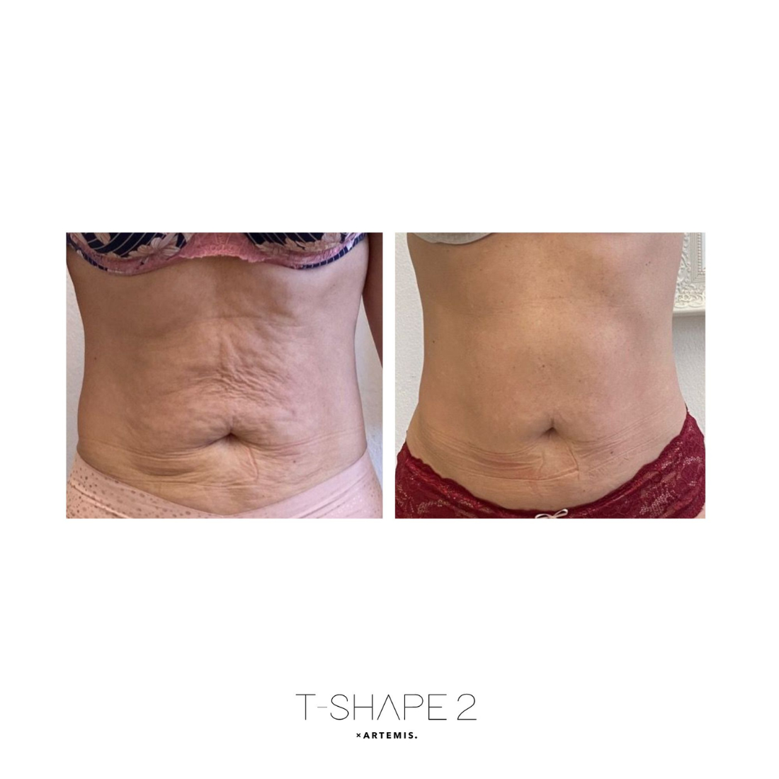 A before and after picture of a woman 's stomach.