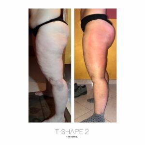 Womans legs looking toned after T-Shape 2 treatment