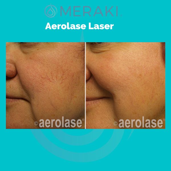 meraki aerolase treatment example cheek