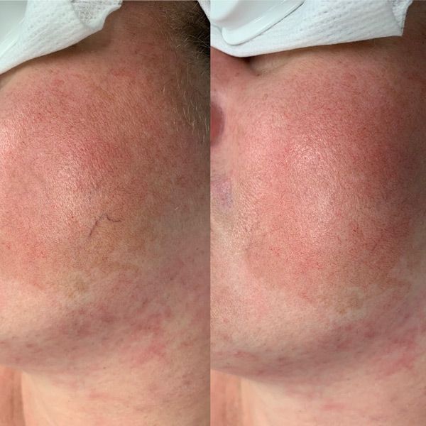 aerolase before and after treatment galley by meraki new york