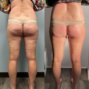 Womans legs before and after having T-Shape 2