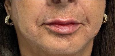 after rf microneedling at meraki mouth