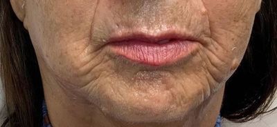 before rf microneedling at meraki mouth