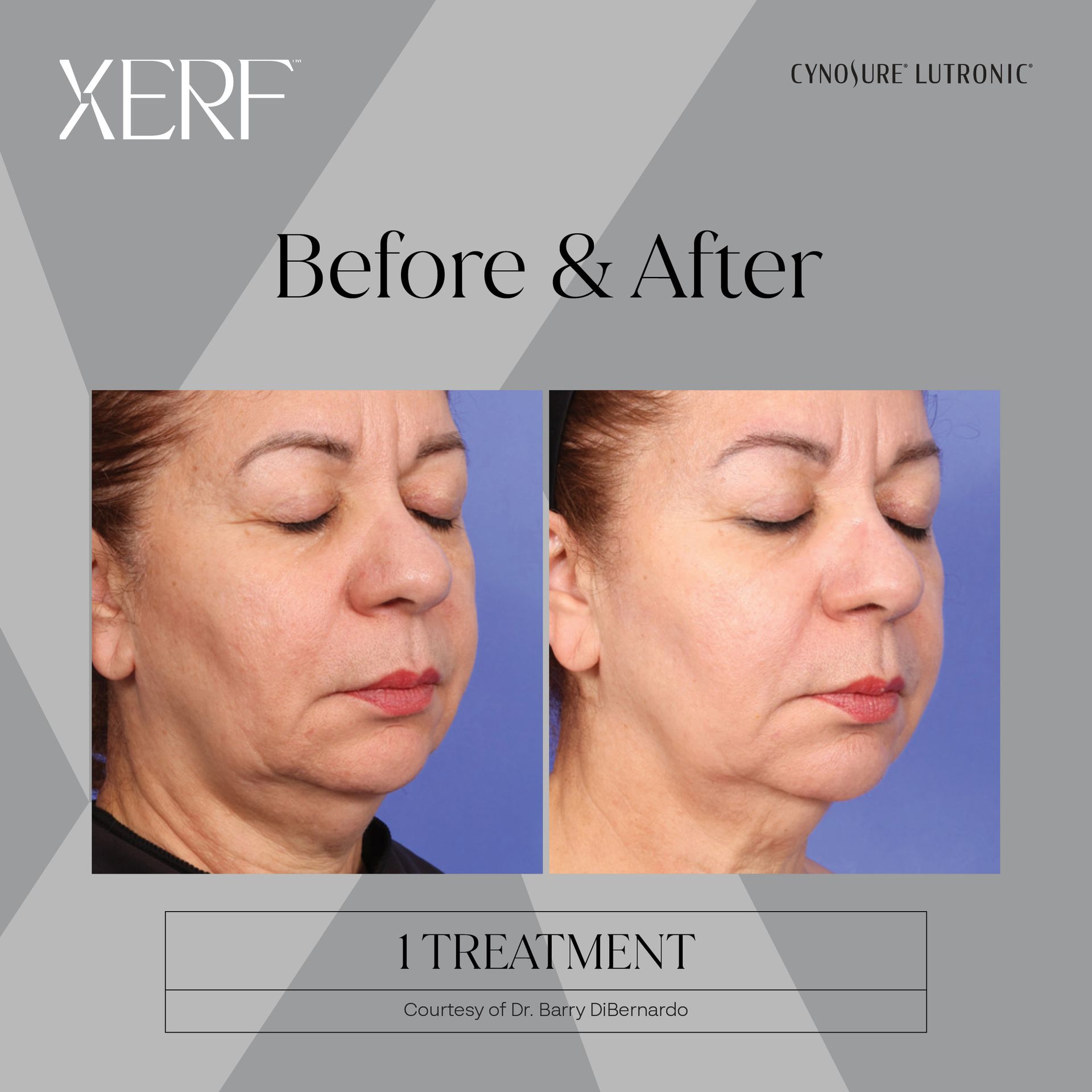 One treatment of XERF before and after
