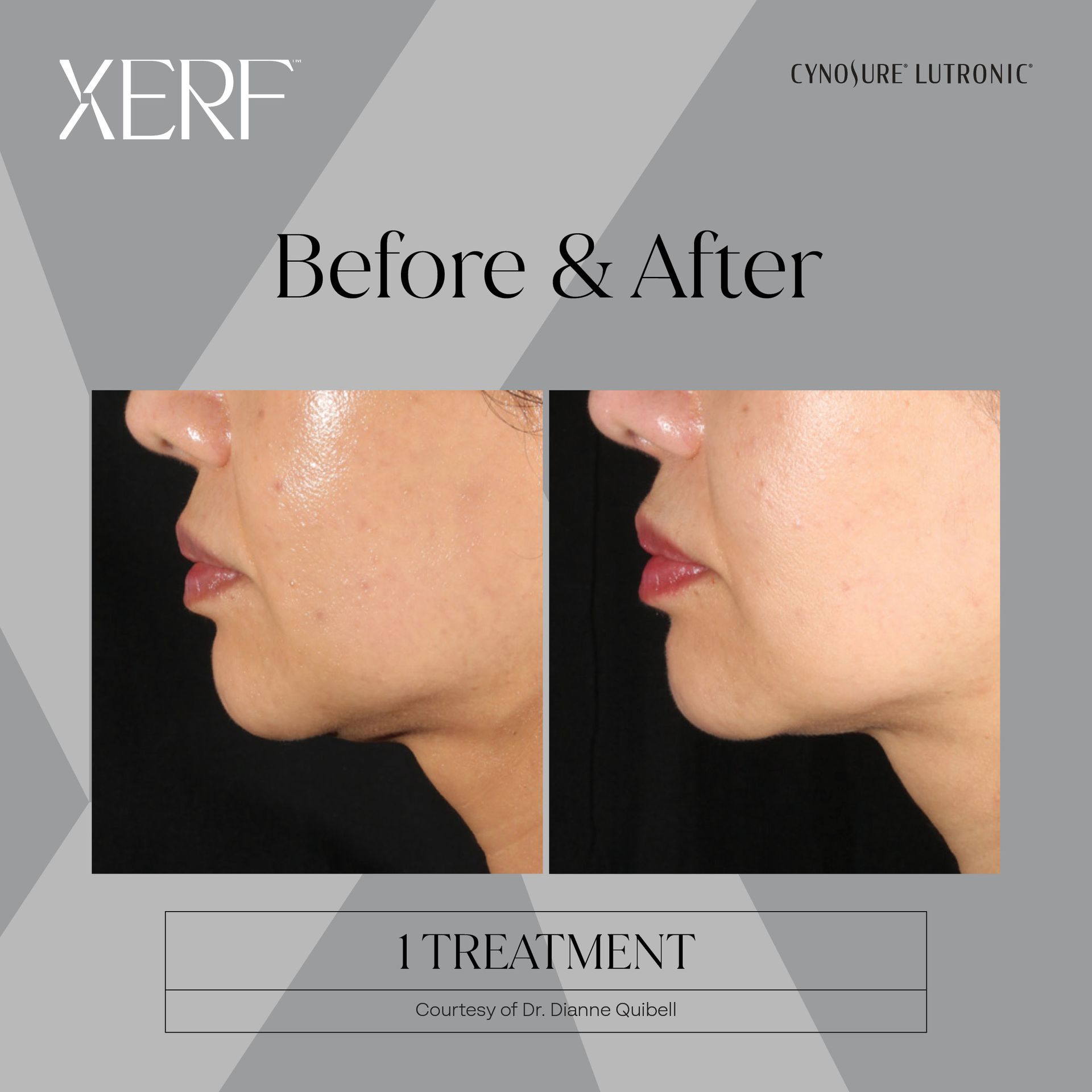 XERF's before and after 1 treatment