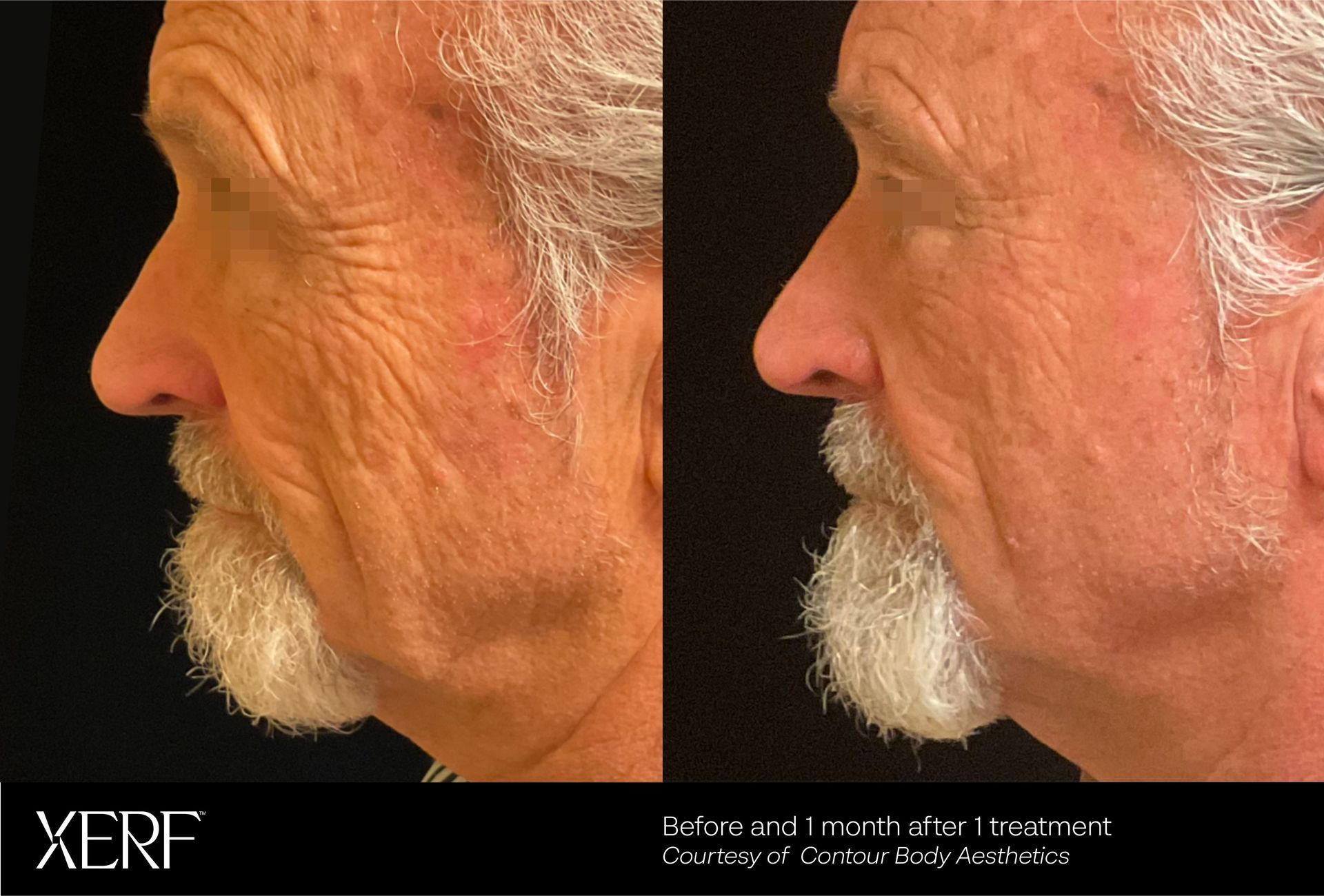 After one treatment of XERF one month later