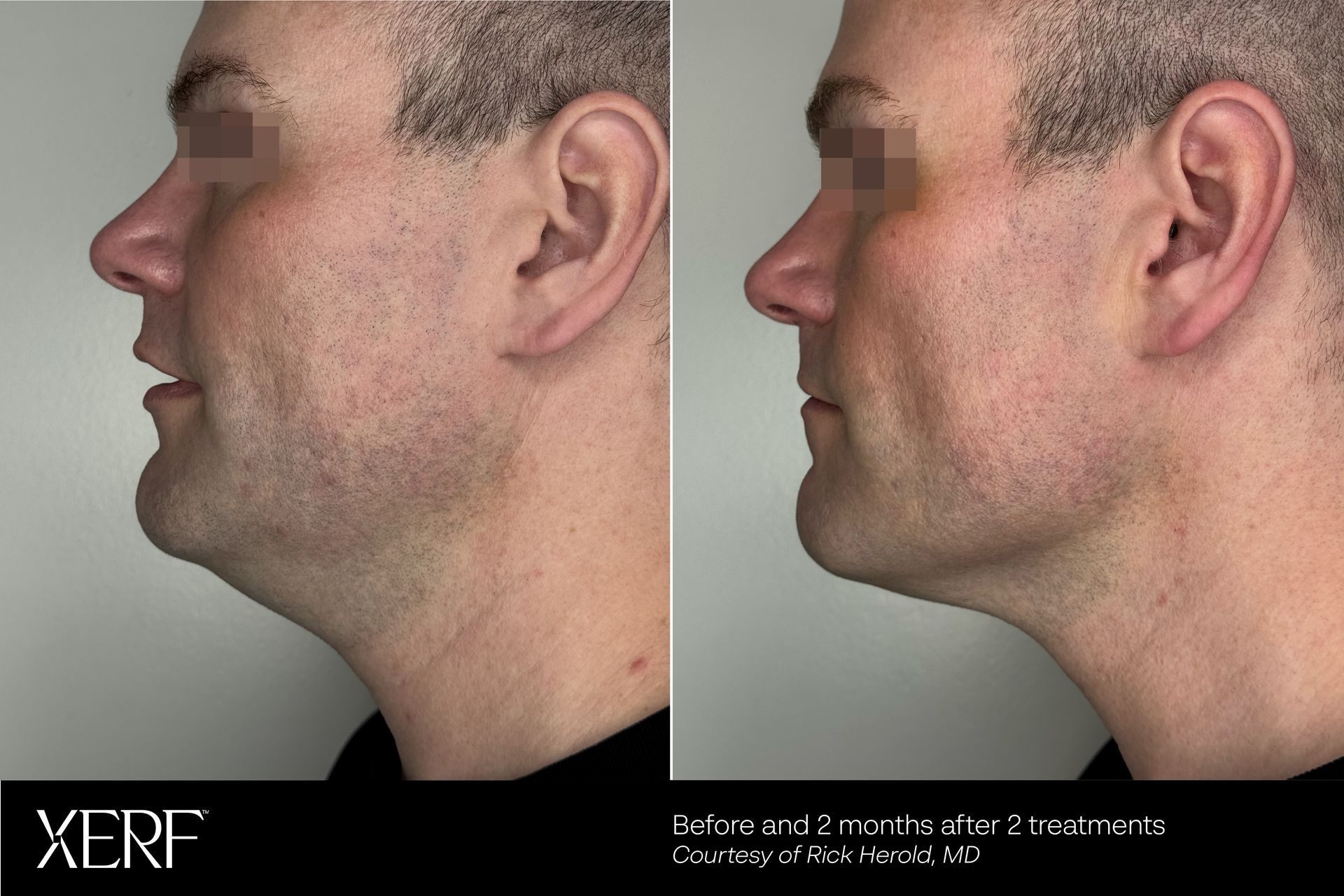 Before and after XERF's treatment after two treatments, two months