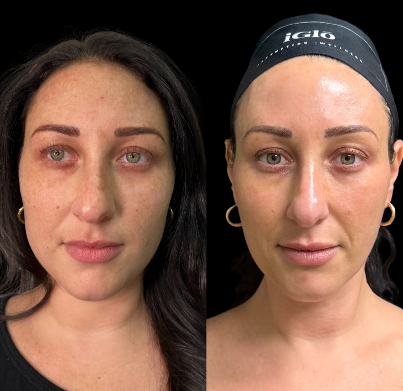 HALO laser before and after skin tone and clarity enhancement