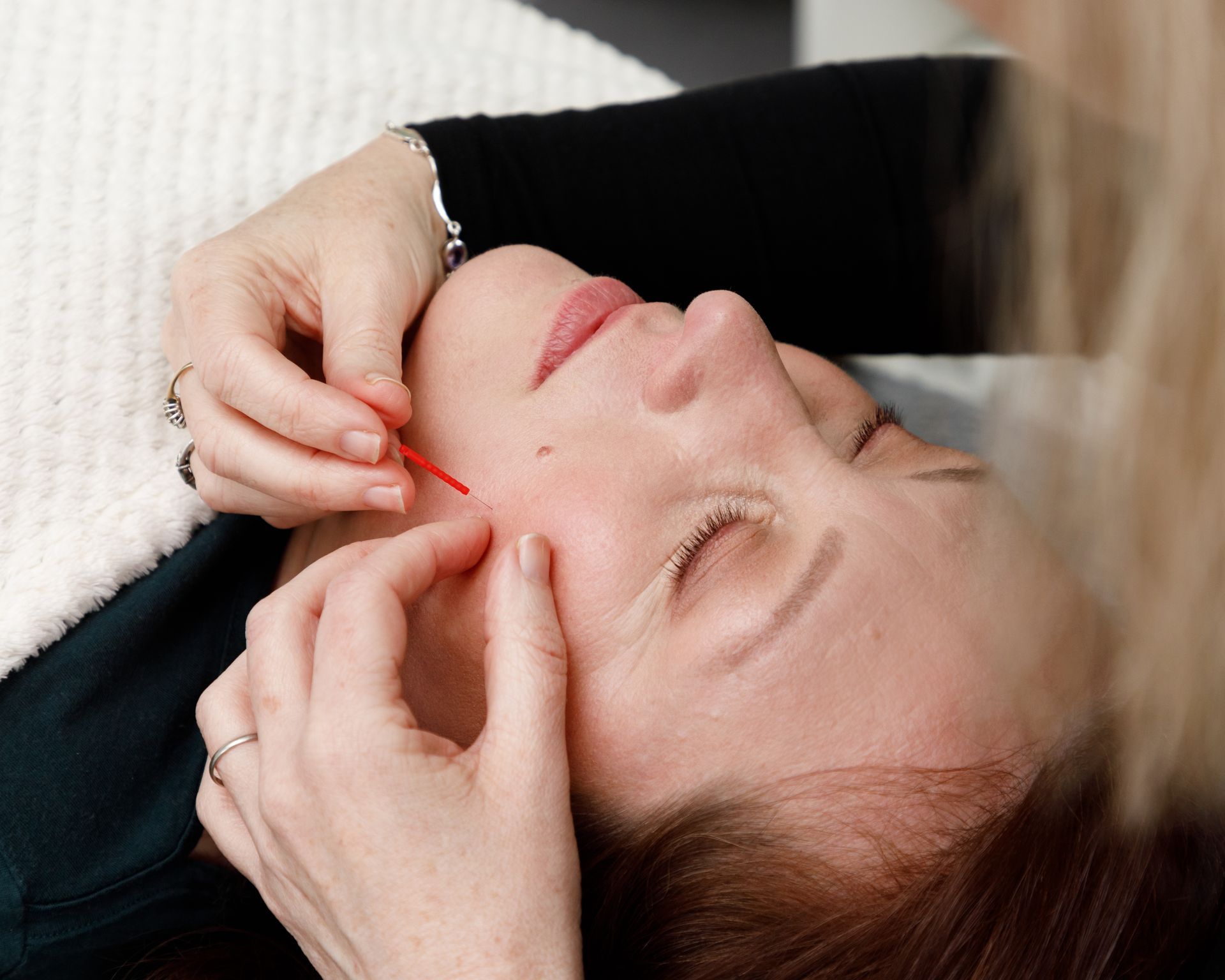 Hands inserting an acupuncture needle into a person's cheek during facial treatment.