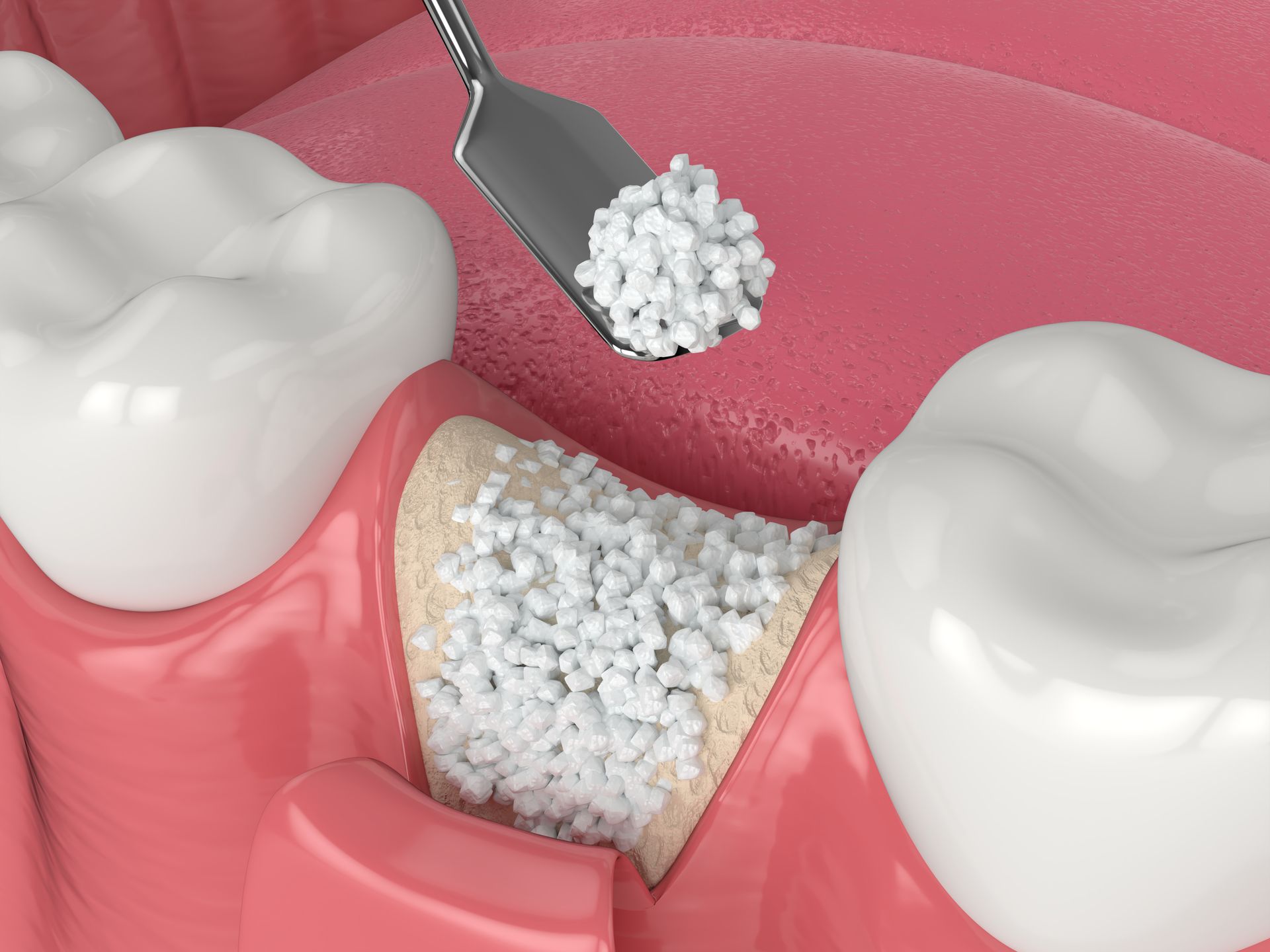 Dental filling being placed into a cavity between two white molars with a metal tool