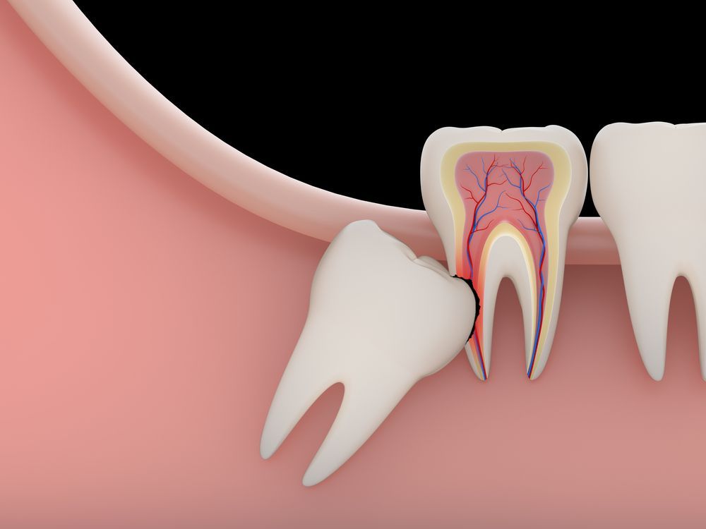 Illustration of an impacted wisdom tooth pressing against a molar in pink gums, showing tooth pain and decay
