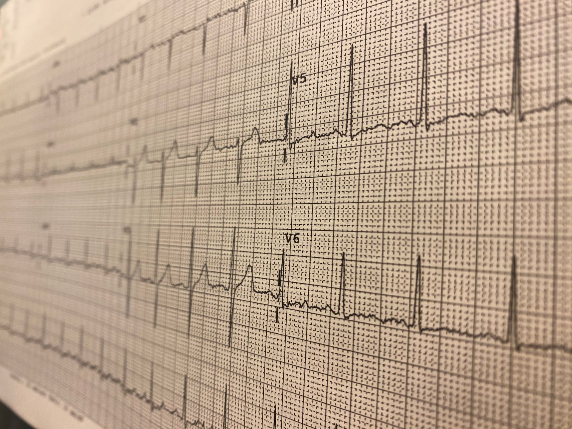 ECG-grafiek met onregelmatige, chaotische hartactiviteit.