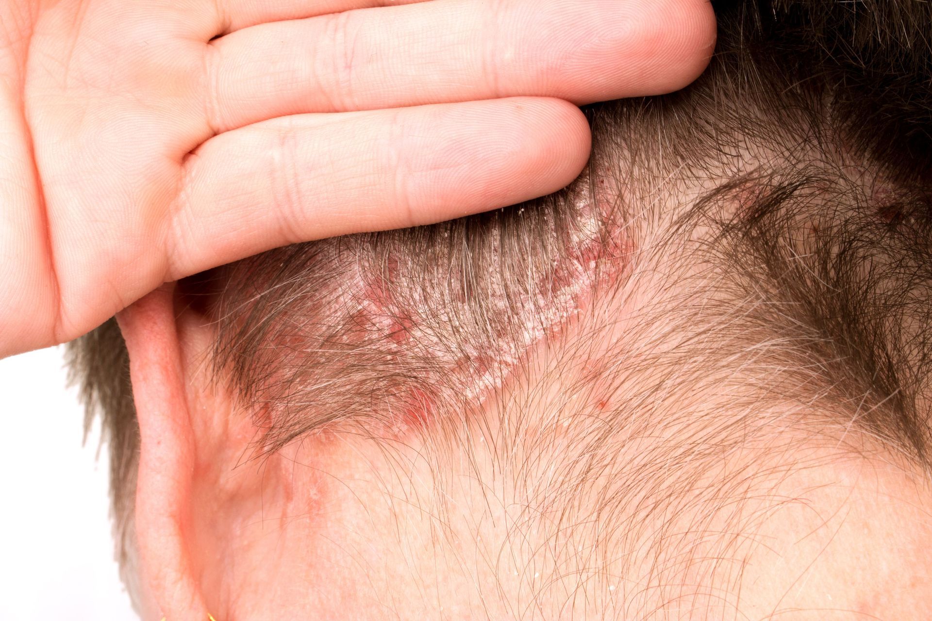 Close-up de uma pessoa separando o cabelo para mostrar uma erupção cutânea vermelha e escamosa no couro cabeludo.