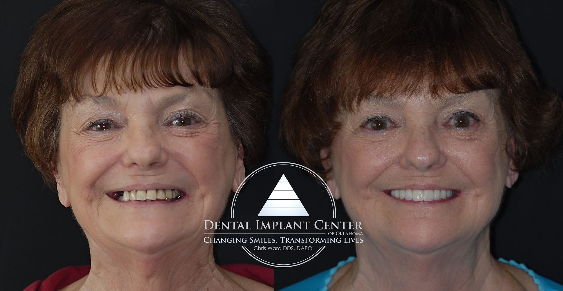 Dental Implant Center of Oklahoma - Before and After