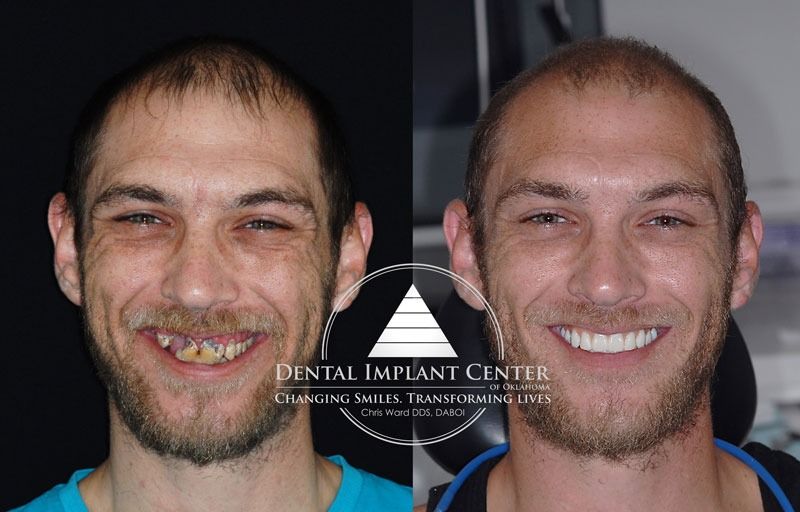 Dental Implant Center of Oklahoma - Before and After
