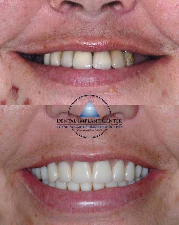 Dental Implant Center of Oklahoma - Before and After