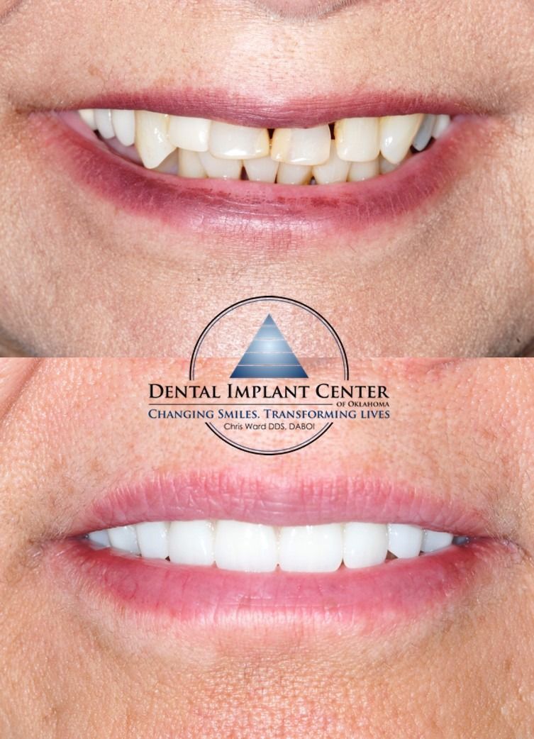 Dental Implant Center of Oklahoma - Before and After