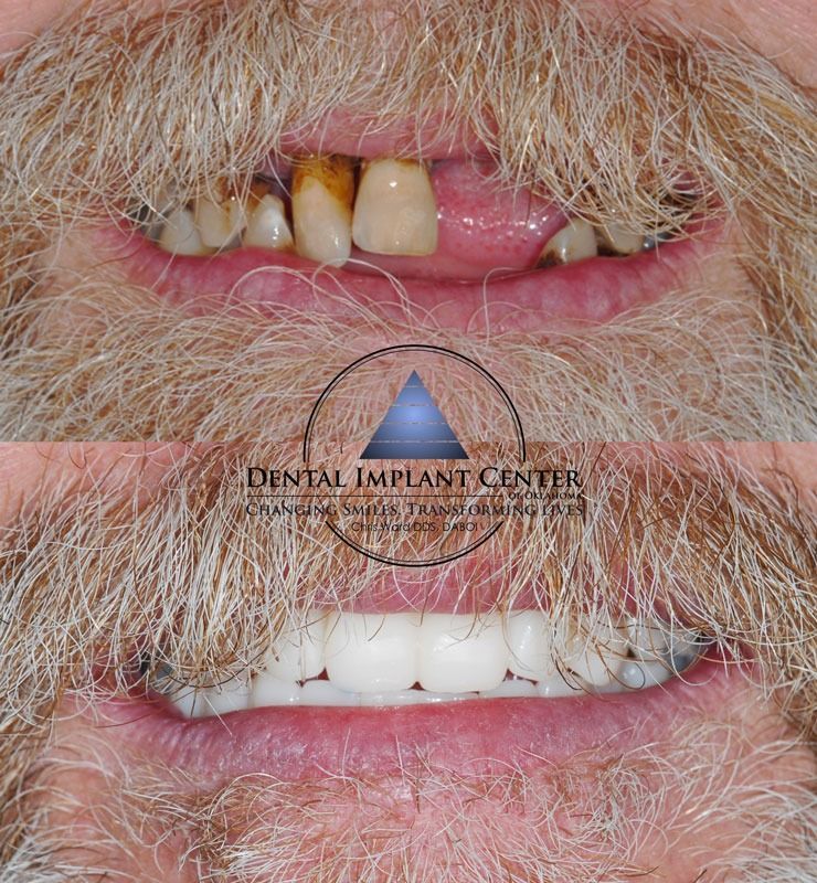 Dental Implant Center of Oklahoma - Before and After