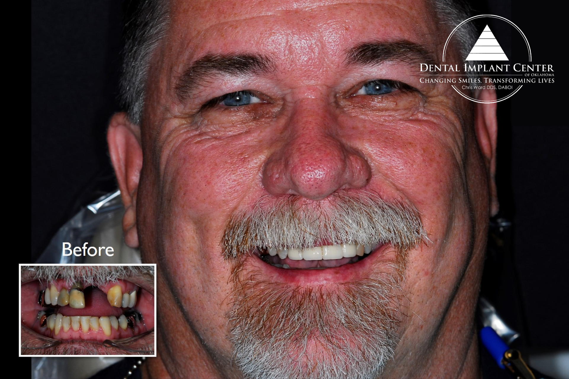 Dental Implant Center of Oklahoma - Before and After