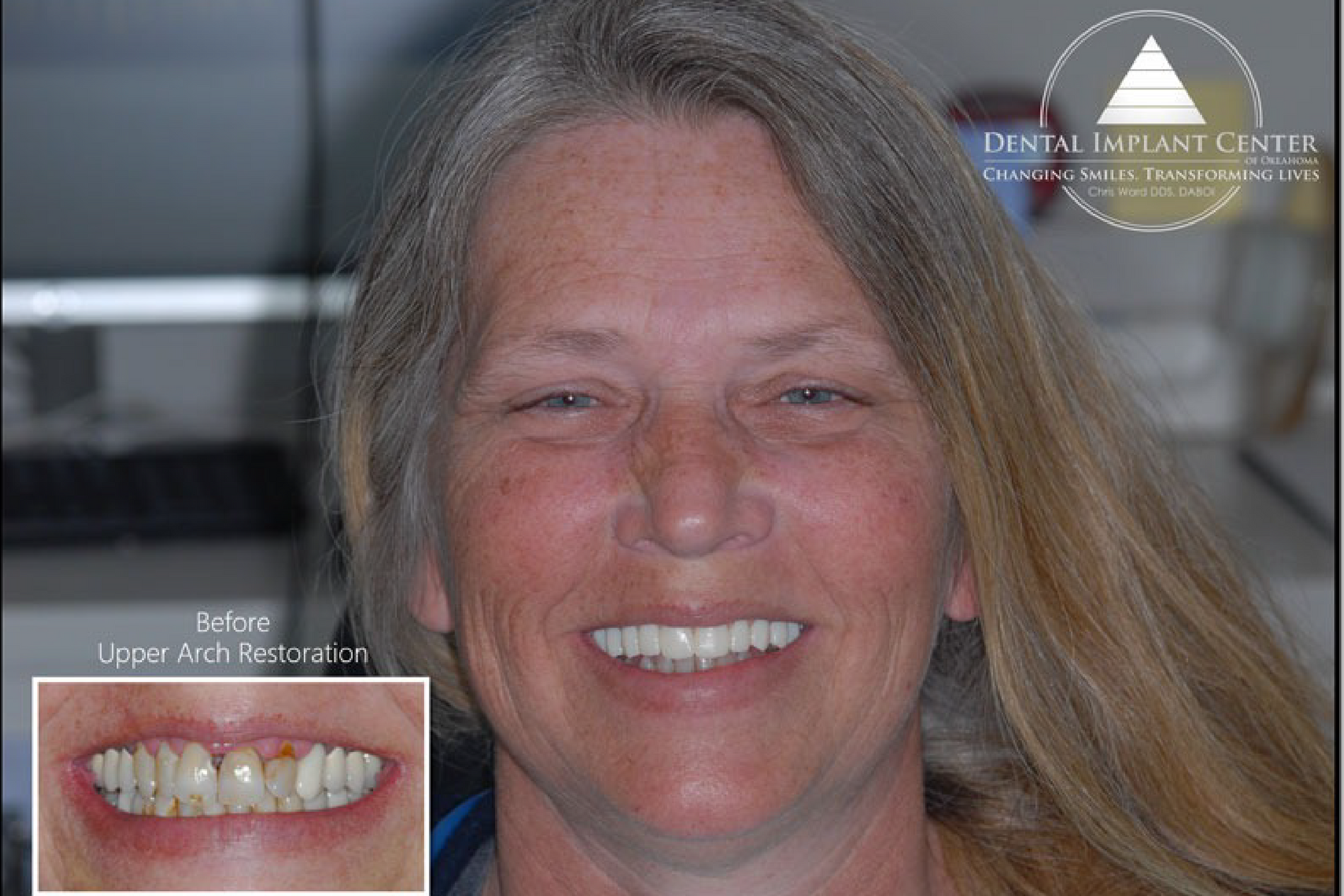 Dental Implant Center of Oklahoma - Before and After
