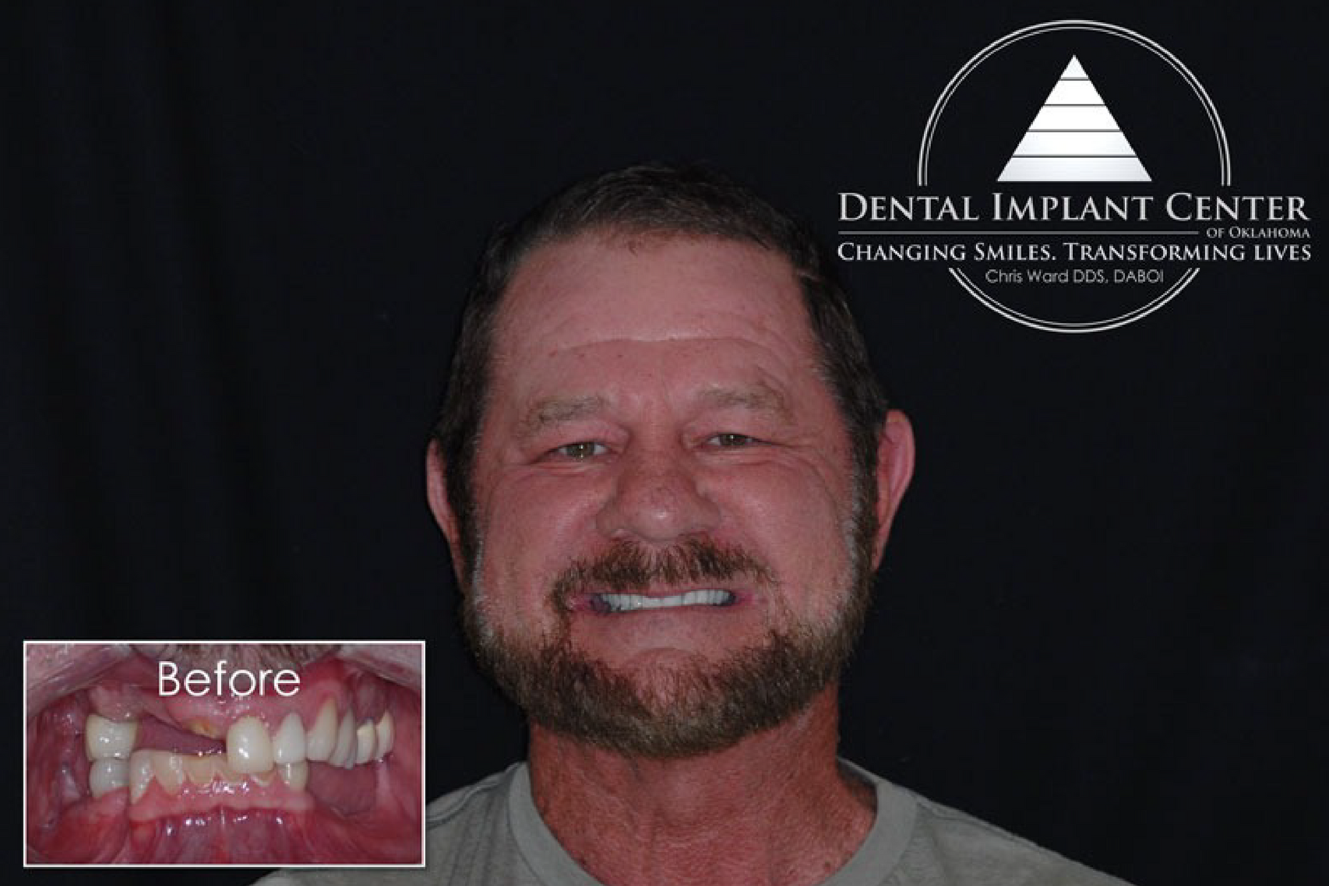 Dental Implant Center of Oklahoma - Before and After