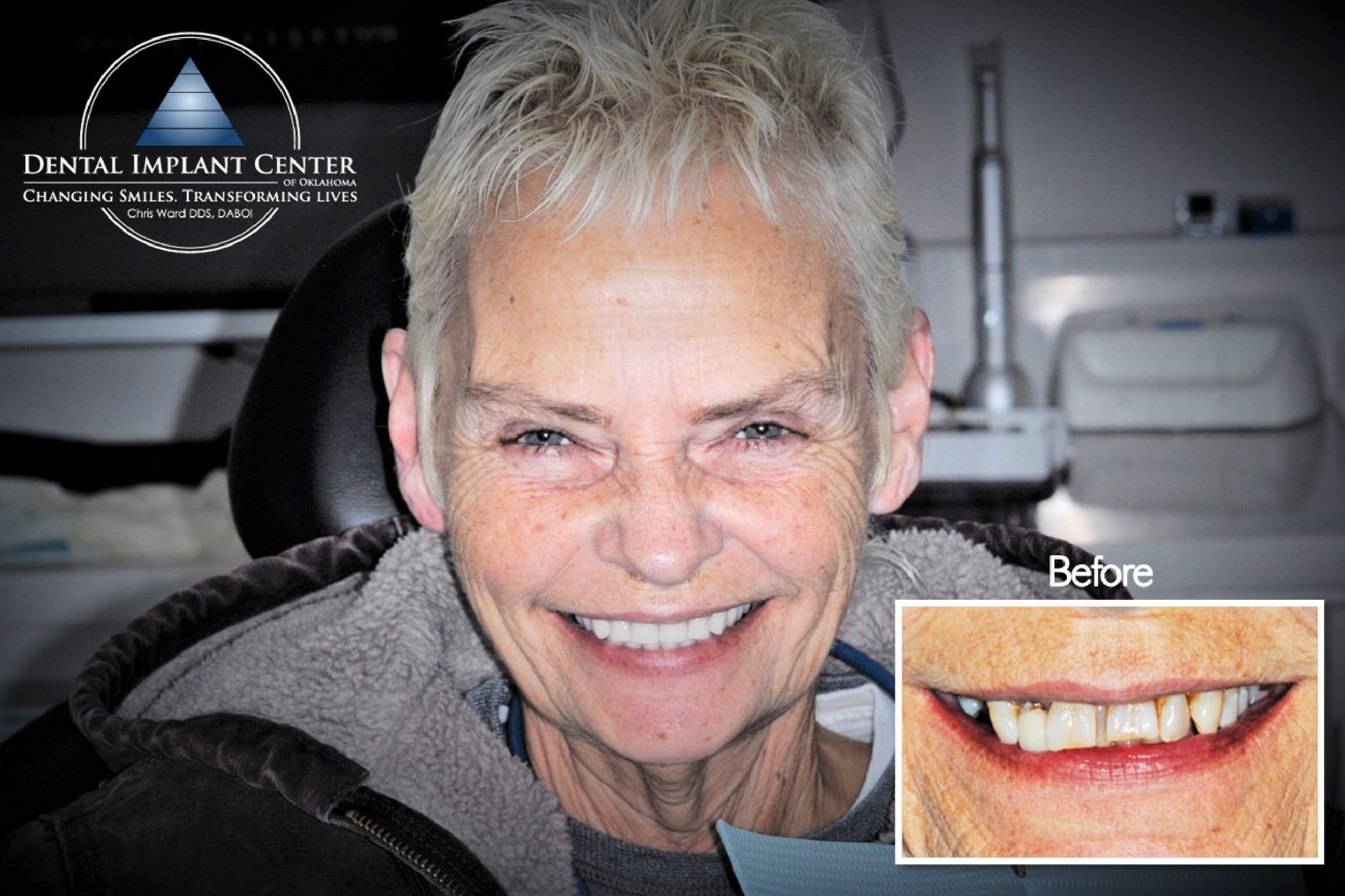 Dental Implant Center of Oklahoma - Before and After