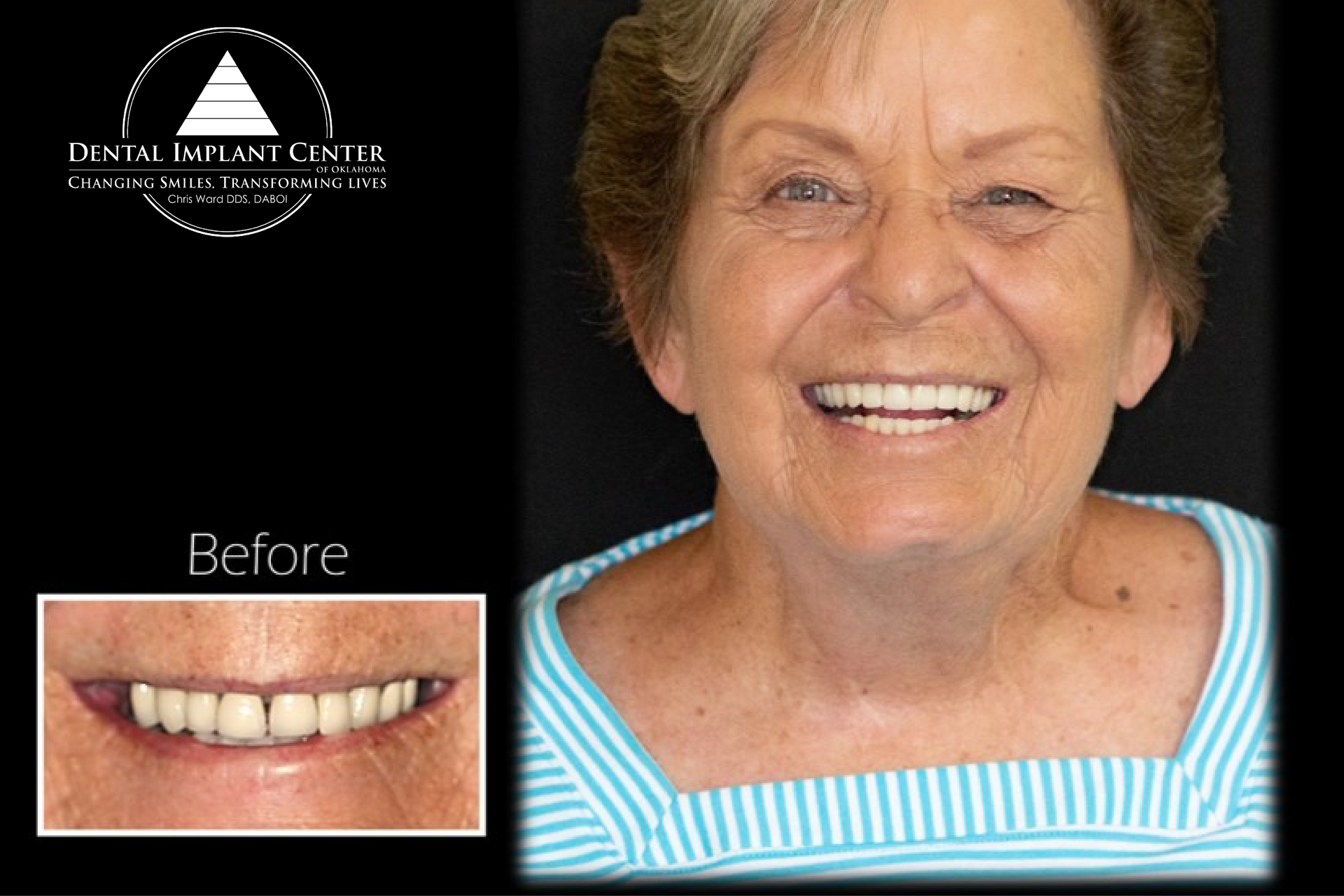 Dental Implant Center of Oklahoma - Before and After