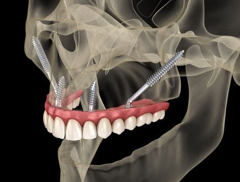 Dentist showing a patient his teeth with a mirror. Both are smiling.