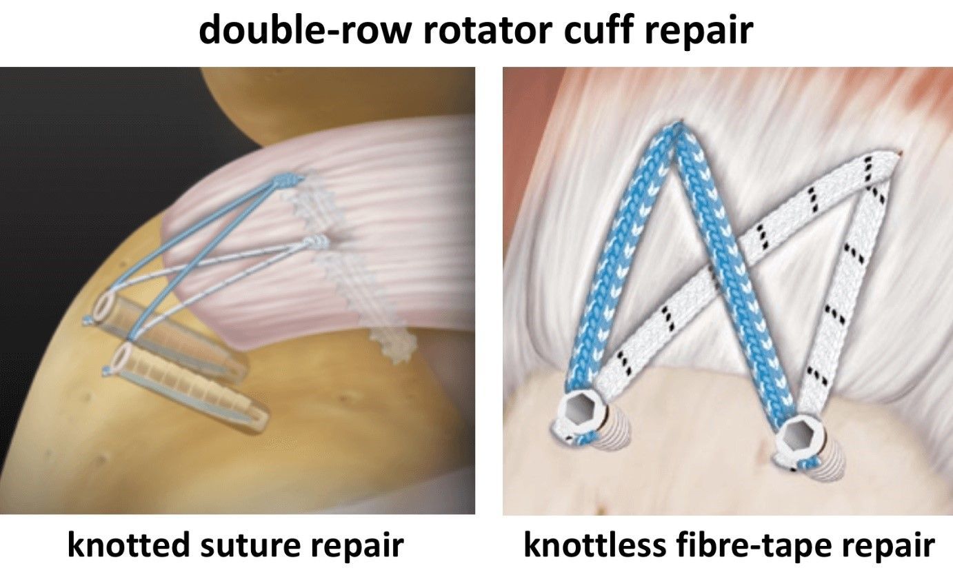 Rotator cuff - double row repair image